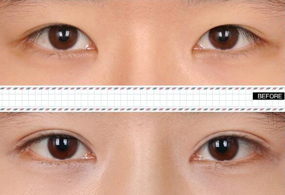 做雙眼皮價格是多少？哪種眼睛適合做雙眼皮呢?