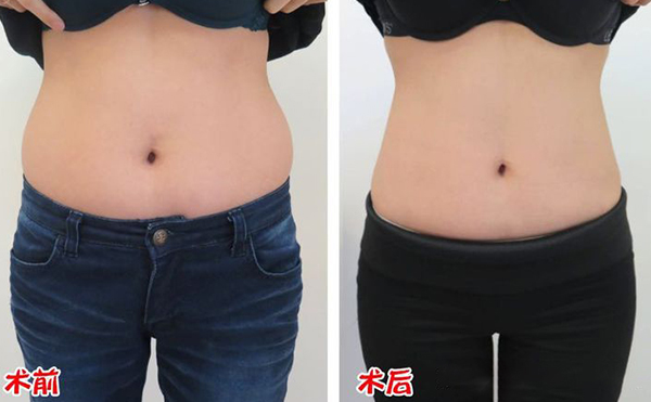 腹部吸脂效果如何？