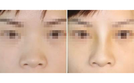 做隆鼻手術(shù)會(huì)留疤嗎？