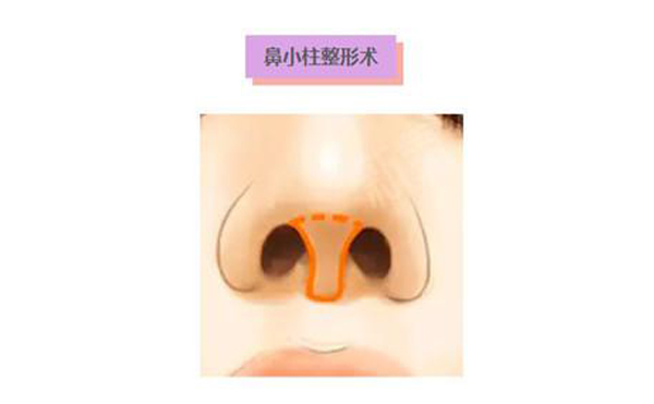 鼻小柱延長術(shù)是什么？鼻小柱延長手術(shù)有什么優(yōu)點