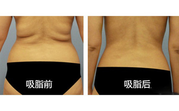 腹部吸脂需要多久恢復(fù)？