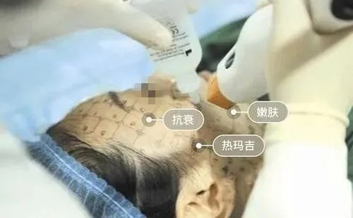 牙齒矯正期間是不能做熱瑪吉嗎？