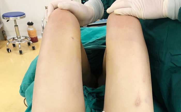 腿部吸脂手術多少錢？腿部吸脂會不會留下后遺癥？