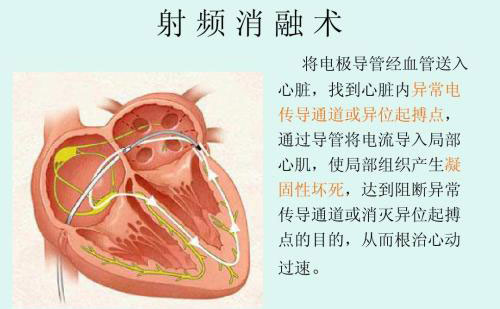 射頻祛眼袋效果怎么樣？