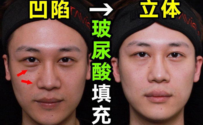 淚溝填充用什么方法最好？淚溝填充手術(shù)大約多少錢(qián)？