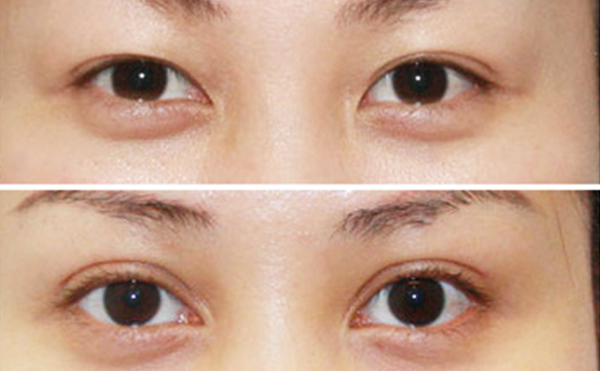 內(nèi)雙做雙眼皮是什么價(jià)格？效果怎么樣？