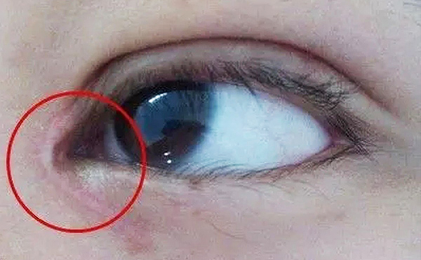 內(nèi)眼角修復(fù)難不難？哪些情況需要修復(fù)?
