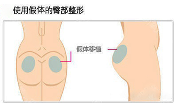假體豐臀多少錢？假體豐臀效果是永久的嗎？