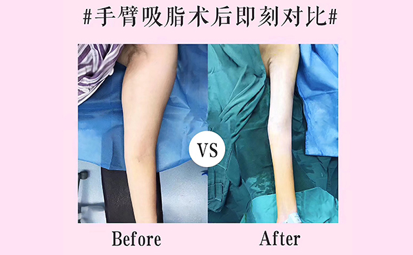 手臂吸脂會反彈嗎？
