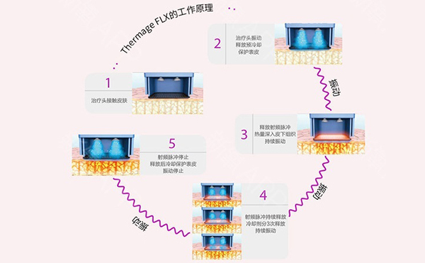 電波拉皮怎么去除魚尾紋？