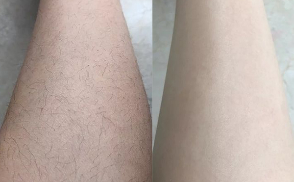 冰點(diǎn)脫腿毛效果怎么樣？