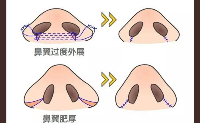 鼻頭肥大怎么改善？鼻頭肥大矯正術多少錢？