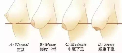 產(chǎn)后胸部下垂怎么辦？
