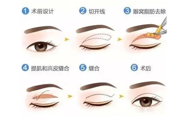 全切雙眼皮跟埋線的區(qū)別是什么？哪個(gè)好？
