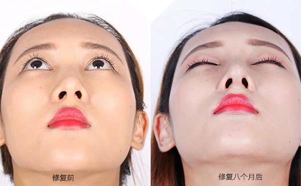 隆鼻手術(shù)失敗怎么辦？修復(fù)費(fèi)用要多少？