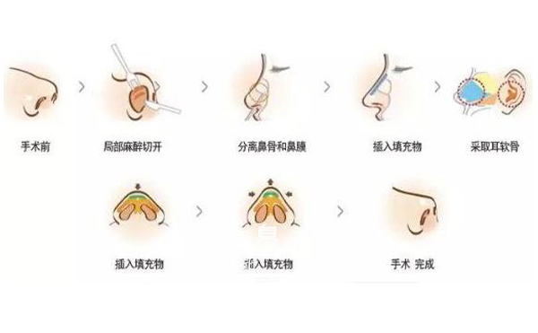 耳軟骨隆鼻效果怎么樣？要多少錢？