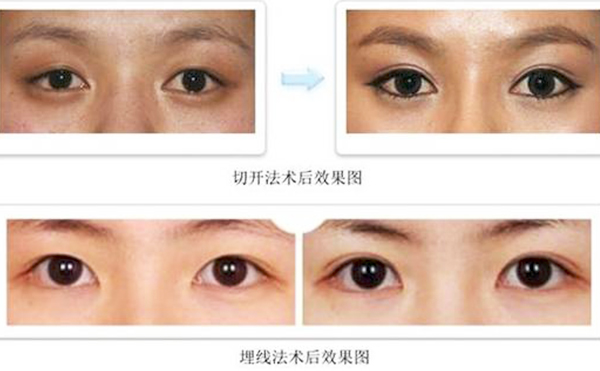 雙眼皮埋線和切開哪個比較好?疼痛程度有什么不同？