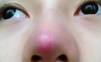 術(shù)后鼻頭發(fā)紅是隆鼻手術(shù)失敗了嗎？該怎么處理？