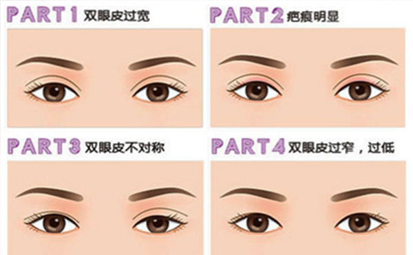 雙眼皮失敗有哪些明顯表現(xiàn)？修復成功率大嗎？