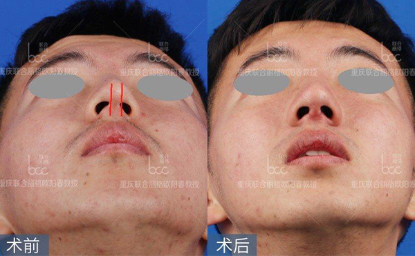歪鼻修復(fù)術(shù)要多少錢？