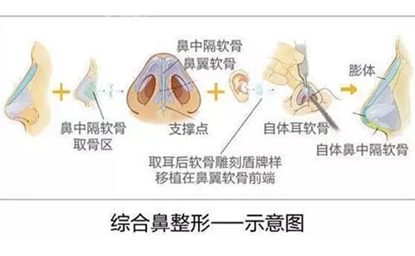 鼻綜合整形的效果怎么樣？鼻綜合手術(shù)安全嗎？