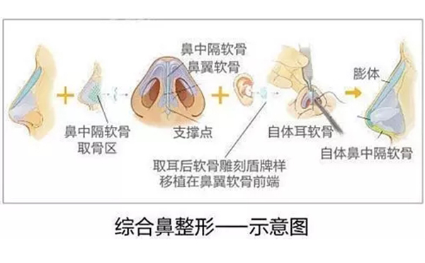 為什么都建議做鼻綜合手術？