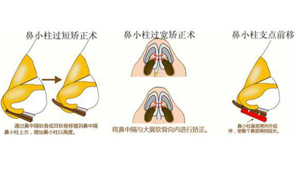 鼻小柱缺損修復(fù)有幾種方法？為什么會(huì)出現(xiàn)鼻小柱缺損的情況