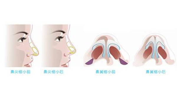 鼻翼縮小整形安全嗎？術(shù)后會(huì)不會(huì)影響呼吸