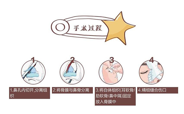 自體軟骨隆鼻為什么這么受歡迎？