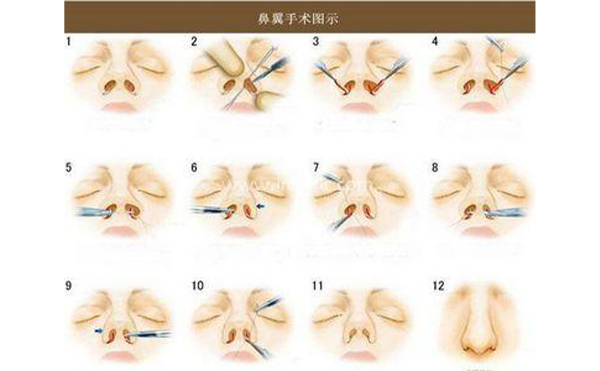 南昌愛(ài)思特做鼻翼縮小怎么樣?時(shí)間久了會(huì)不會(huì)反彈