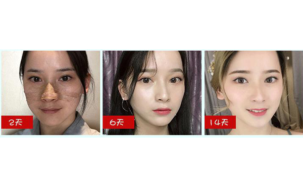 全肋鼻和半肋鼻有什么區(qū)別？做全肋好還是半肋好