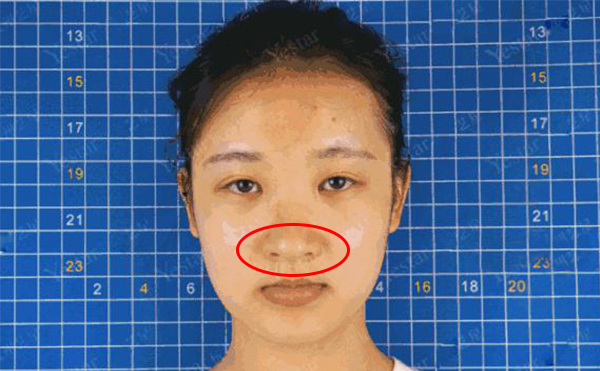 鼻頭肥大是什么原因造成的？怎么解決鼻頭肥大
