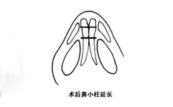 鼻小柱延長(zhǎng)可靠嗎？手術(shù)難度大嗎