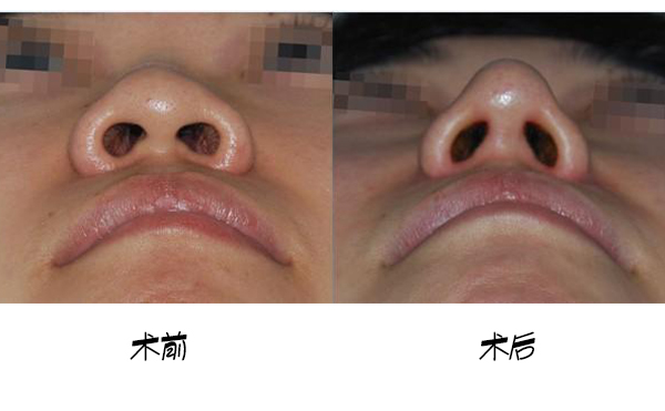 鼻小柱延長(zhǎng)手術(shù)的大致流程是什么？手術(shù)成功率高嗎