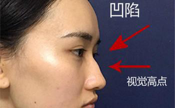駝峰鼻整形是怎么做的？不同嚴(yán)重程度的駝峰鼻矯正方法一樣嗎？