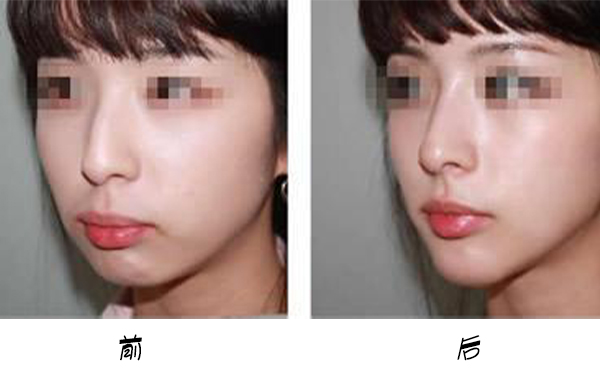 箭鼻是怎么出現(xiàn)的?箭鼻矯正是如何操作的？