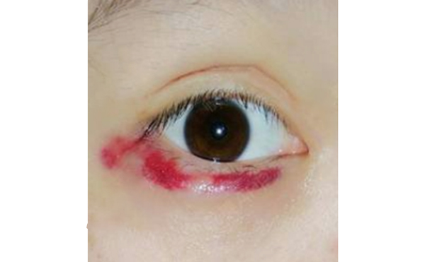 自體脂肪豐臥蠶有風(fēng)險嗎?術(shù)后怎么護理?