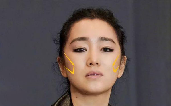 什么原因?qū)е嘛E骨外擴(kuò)？