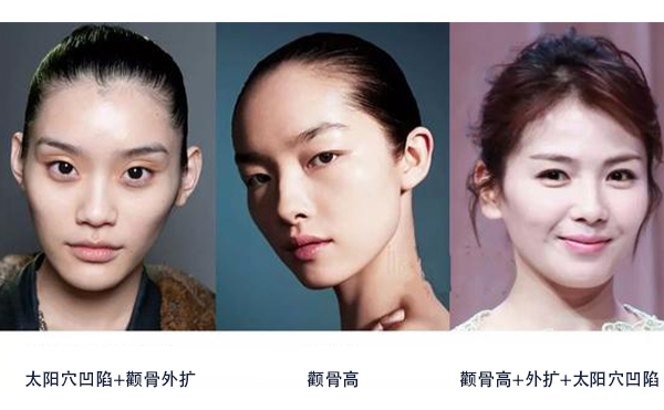 怎么區(qū)分是顴骨高還是太陽穴凹陷？