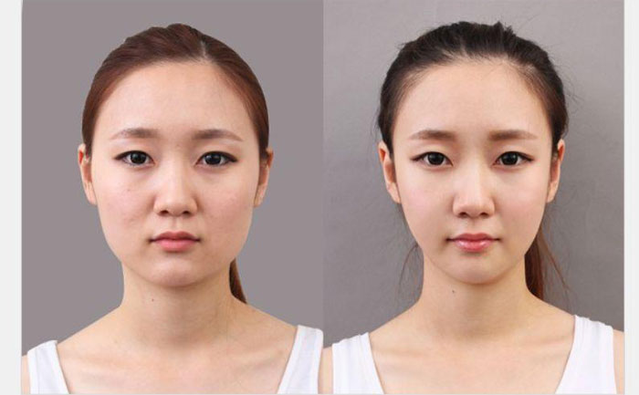 非手術(shù)瘦臉多少錢？非手術(shù)瘦臉方法有哪些？