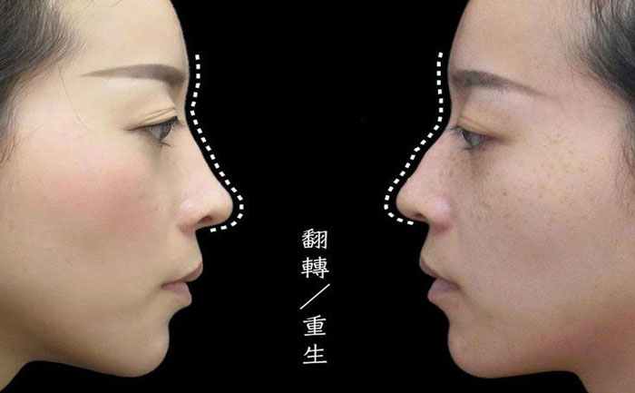 駝峰鼻矯正手術(shù)多少錢？駝峰鼻怎么改善？