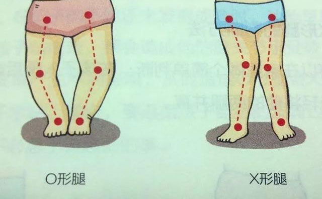 羅圈腿怎樣矯正？羅圈腿手術矯正多少錢？