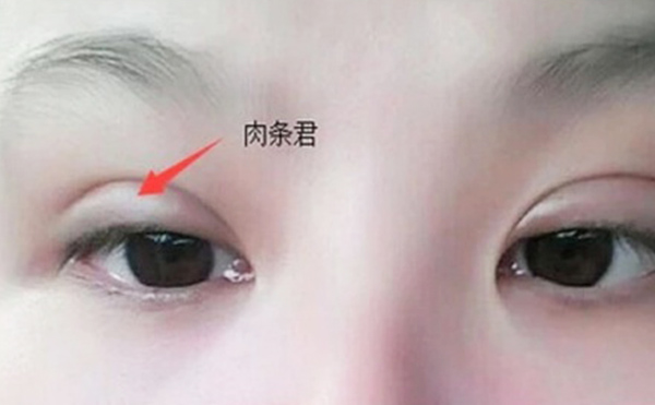雙眼皮不自然怎么補(bǔ)救？雙眼皮肉條好修復(fù)么？