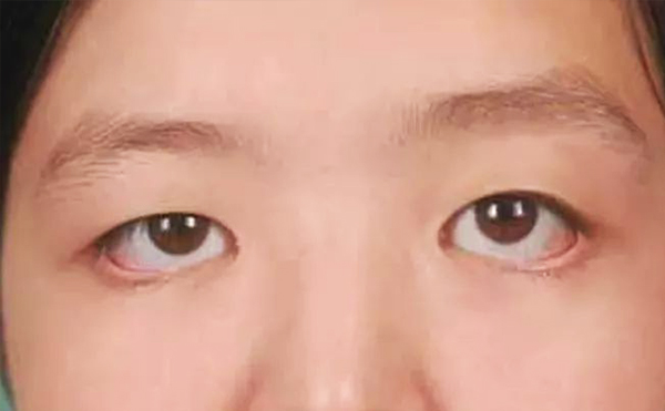 眼袋修復(fù)一般多少錢(qián)?眼袋修復(fù)術(shù)后怎么護(hù)理?