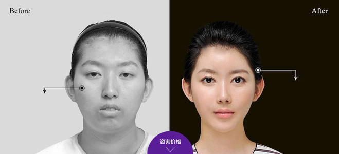 下頜角整形的方法有哪些？