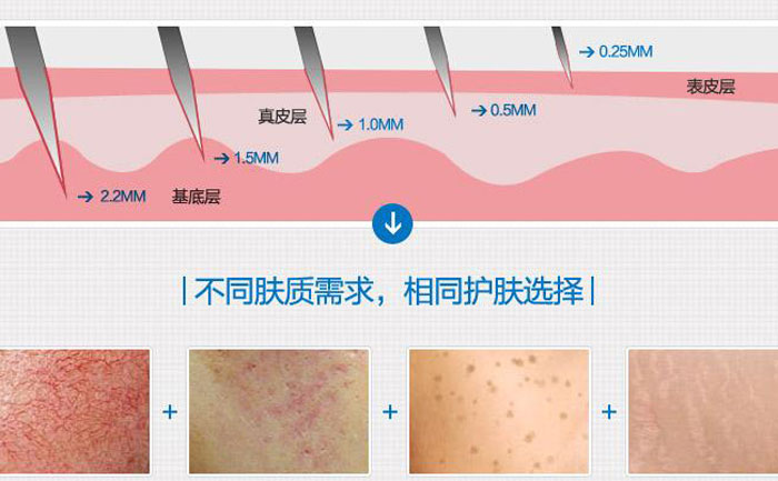 微針去痘坑多少錢一次？
