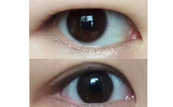 水泡眼矯正術安全不安全?一般需要多少錢?