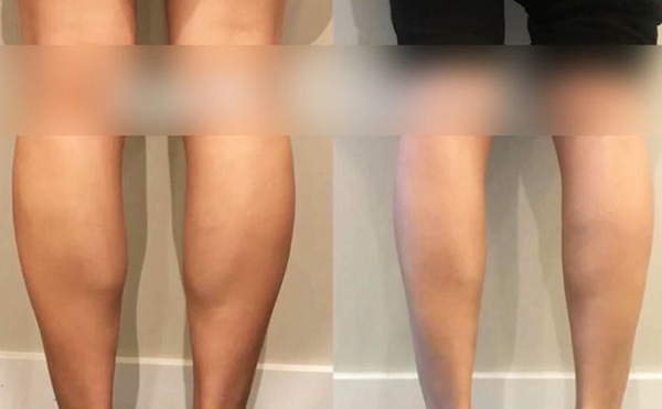 打瘦腿針是怎么操作的？