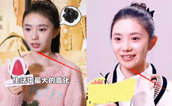 玻尿酸隆下巴整形攻略【優(yōu)勢(shì)、適宜人群、注意事項(xiàng)】