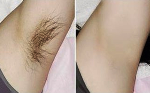 光子脫腋毛有什么優(yōu)勢(shì)？
